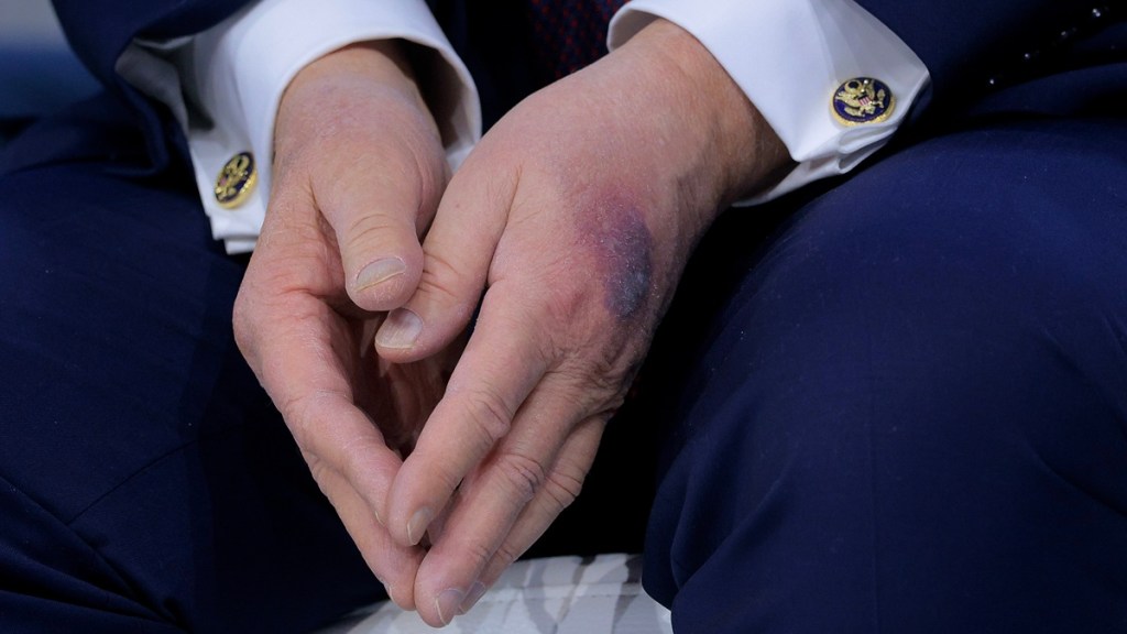 Donald Trump Hand Bruise Davos Excuse Explained Table