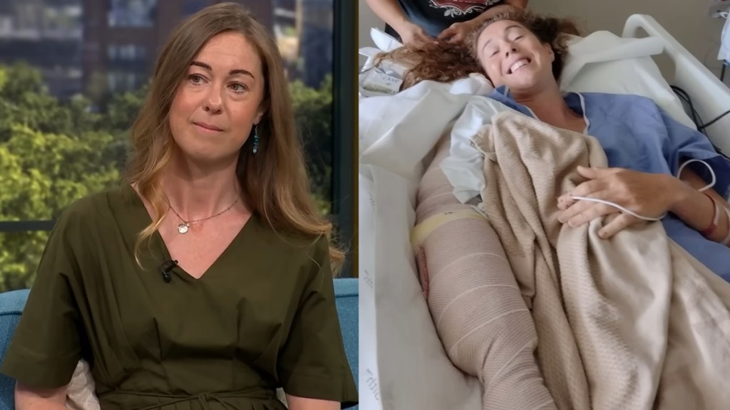 Woman Shows Arm Shark Attack Missing Hawaiit